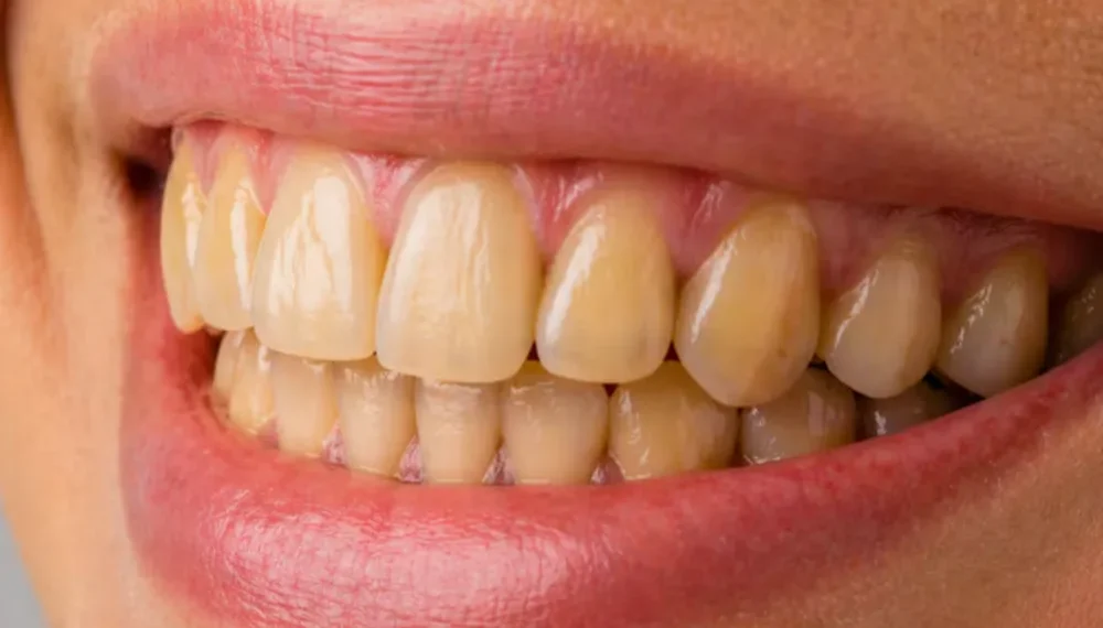 Factores determinantes en la coloración amarillenta de las piezas dentales