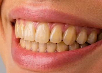 Factores determinantes en la coloración amarillenta de las piezas dentales