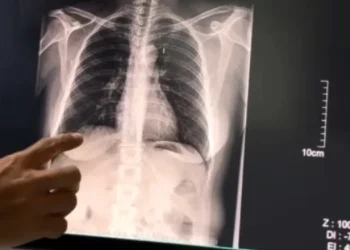 El 40% de los pacientes que asistieron al Consultorio de Cesación Tabáquica del Hospital Marcial Quiroga lograron dejar de fumar