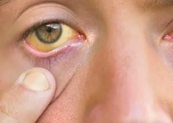 Alerta epidemiológica en Argentina por un marcado brote de Hepatitis A: el 75% de los casos son adultos jóvenes