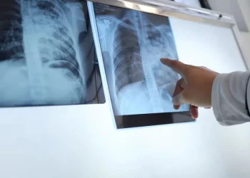 Preocupación por el aumento de tuberculosis en Argentina: cuál es la situación epidemiológica en San Juan