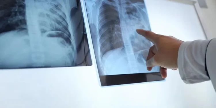 Preocupación por el aumento de tuberculosis en Argentina: cuál es la situación epidemiológica en San Juan
