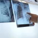 Preocupación por el aumento de tuberculosis en Argentina: cuál es la situación epidemiológica en San Juan