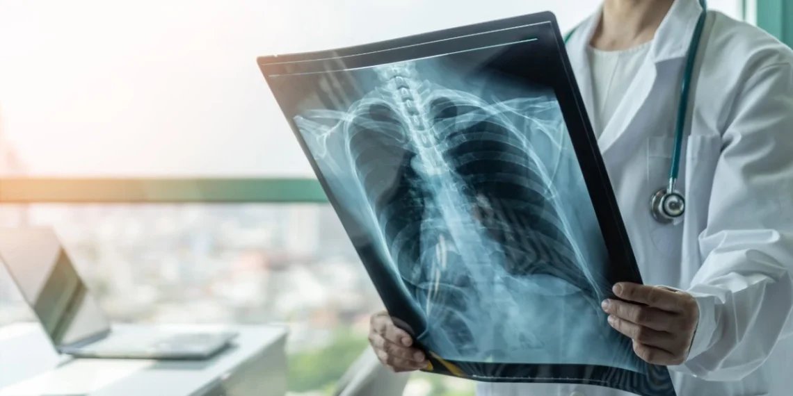 Alerta por virus respiratorios: el aumento de casos de VSR impacta en las notificaciones de neumonía y bronquiolitis