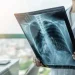 Alerta por virus respiratorios: el aumento de casos de VSR impacta en las notificaciones de neumonía y bronquiolitis