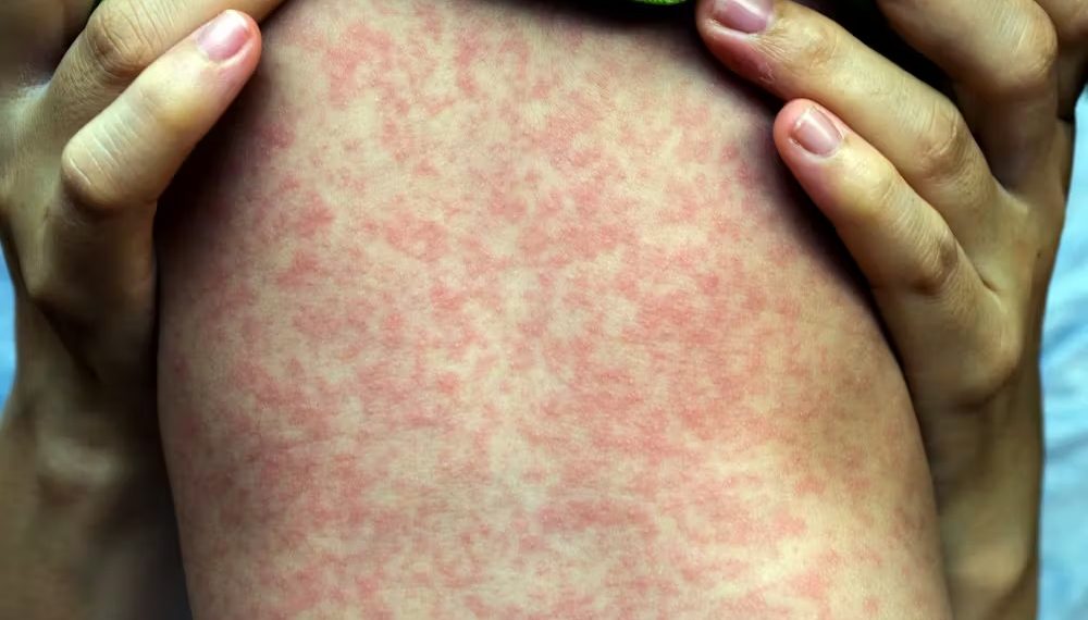Alerta sanitaria: refuerzan la vigilancia epidemiológica ante el riesgo de reingreso del sarampión por el flujo turístico