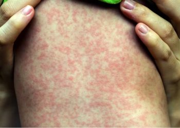Alerta sanitaria: refuerzan la vigilancia epidemiológica ante el riesgo de reingreso del sarampión por el flujo turístico