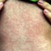 Alerta sanitaria: refuerzan la vigilancia epidemiológica ante el riesgo de reingreso del sarampión por el flujo turístico