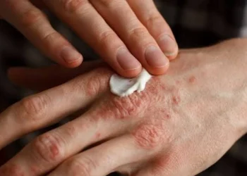 Campaña de salud gratuita en San Juan: realizarán controles para la detección temprana de psoriasis y artritis psoriásica en el Hospital Rawson
