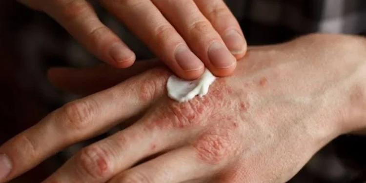 Campaña de salud gratuita en San Juan: realizarán controles para la detección temprana de psoriasis y artritis psoriásica en el Hospital Rawson