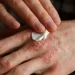 Campaña de salud gratuita en San Juan: realizarán controles para la detección temprana de psoriasis y artritis psoriásica en el Hospital Rawson