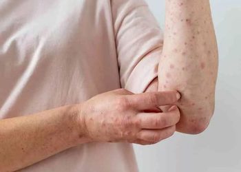 Salud en San Juan: descartan circulación de Mpox y advierten por el avance de influenza y metaneumovirus