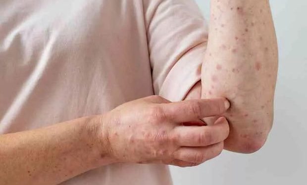 Salud en San Juan: descartan circulación de Mpox y advierten por el avance de influenza y metaneumovirus