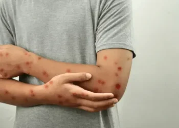 Detectaron un caso de la enfermedad Mpox en San Juan: corresponde a la variante clado Ib