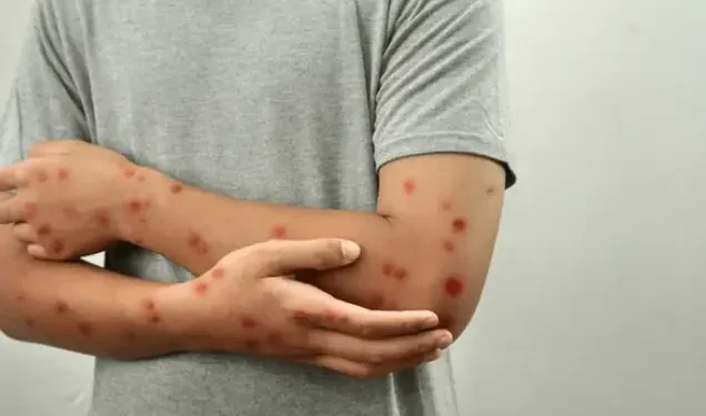 Detectaron un caso de la enfermedad Mpox en San Juan: corresponde a la variante clado Ib