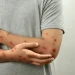 Detectaron un caso de la enfermedad Mpox en San Juan: corresponde a la variante clado Ib