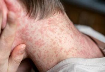 Alivio sanitario: descartaron un caso sospechoso de sarampión en un niño de Caucete