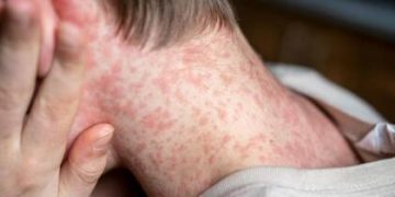 Alivio sanitario: descartaron un caso sospechoso de sarampión en un niño de Caucete